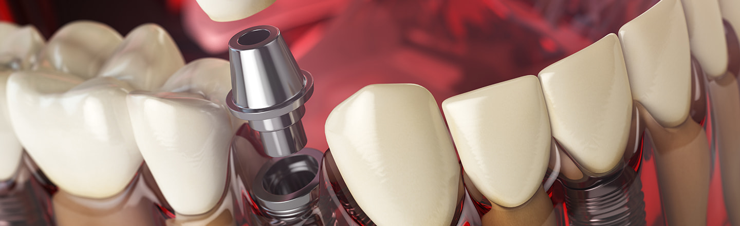 All-on-4 Dental Implantlar