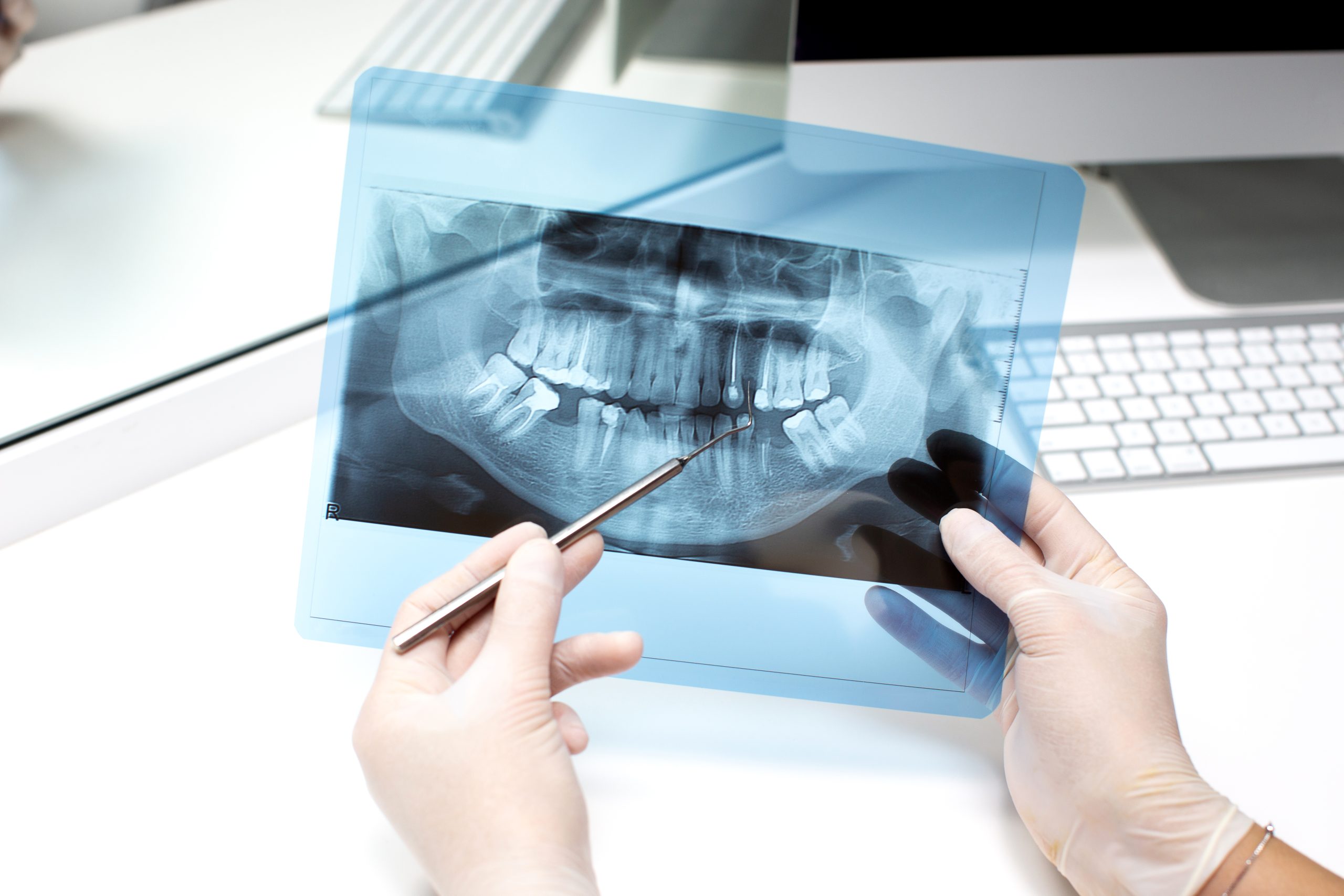 Dental İmplantlar, Köprüler ve Protez Dişler: Hangisi Sizin İçin Uygun?