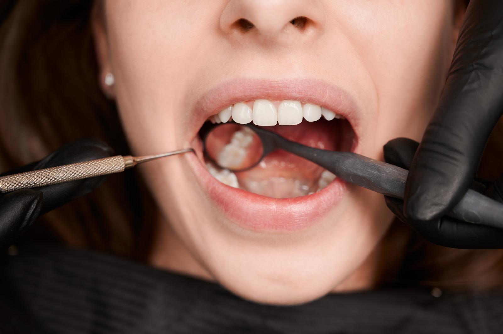 Diş taşı temizliği sonrası nelere dikkat edilmeli?